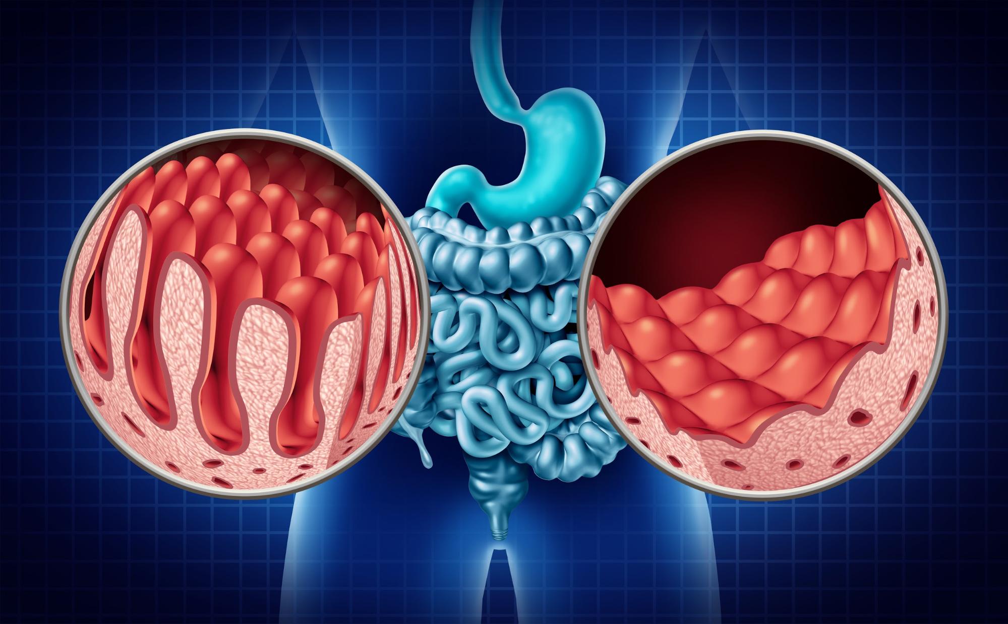 How gut dysfunction could be the hidden trigger for chronic illness